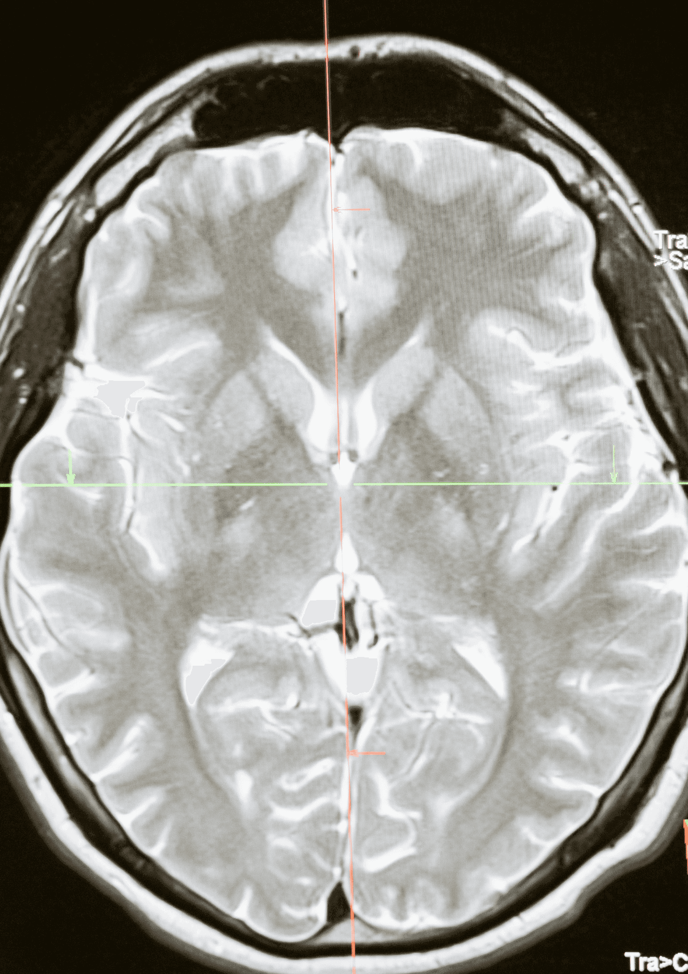 Hyperbaric oxygen therapy, used for brain health support at Biowell
