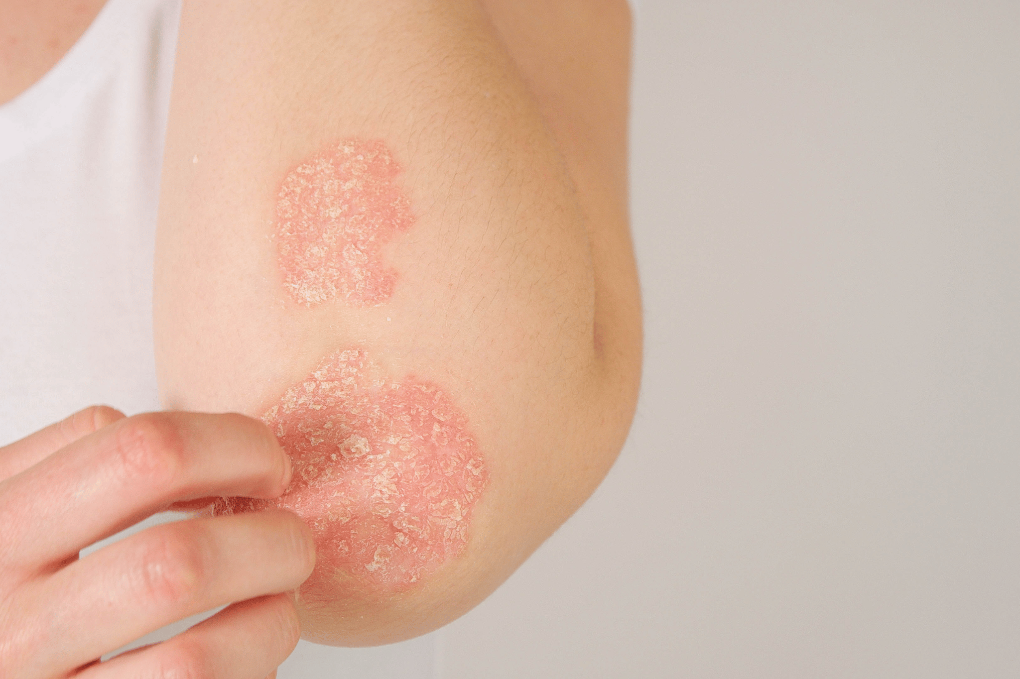 Biohacking therapies for chronic skin conditions, including eczema, psoriasis, and acne